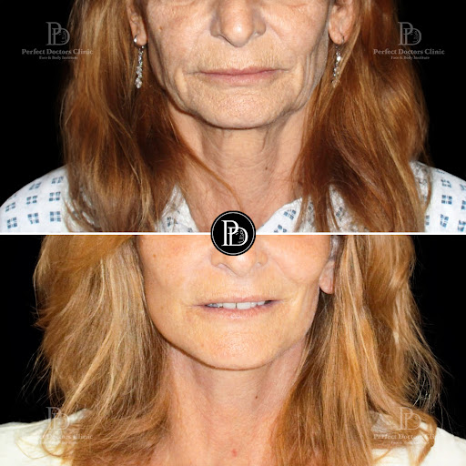 Perfect Doctors Clinic Dubai Rhinoplasty BBL Liposuction Gynecomastia tummy tuck facelift Breast body lift butt fillers botox — BEAUTY in Dubai — photo 1