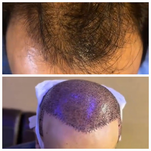 Glamorous Hair Transplant in Dubai | Glam Hair Clinic - FUE Hair Transplant Dubai, FUT Transplant, BioFibre, DHI — BEAUTY in Dubai — photo 1