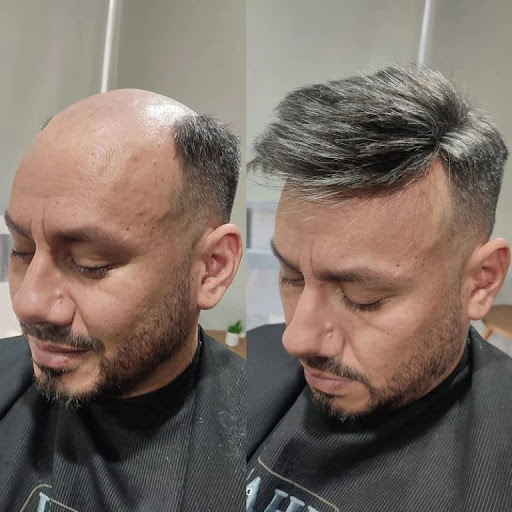Glamorous Hair Transplant in Dubai | Glam Hair Clinic - FUE Hair Transplant Dubai, FUT Transplant, BioFibre, DHI — BEAUTY in Dubai — photo 3