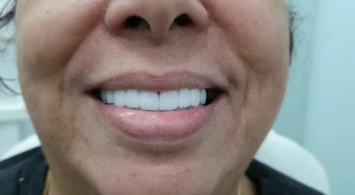 Veneers Dental Centre — BEAUTY in Dubai — photo 2