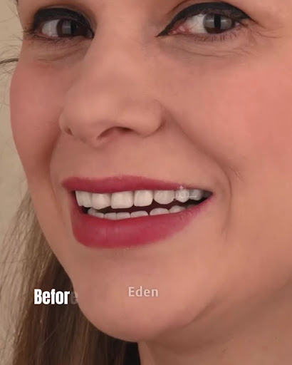 EDEN Dental Clinic | Hollywood Smile — BEAUTY in Dubai — photo 2