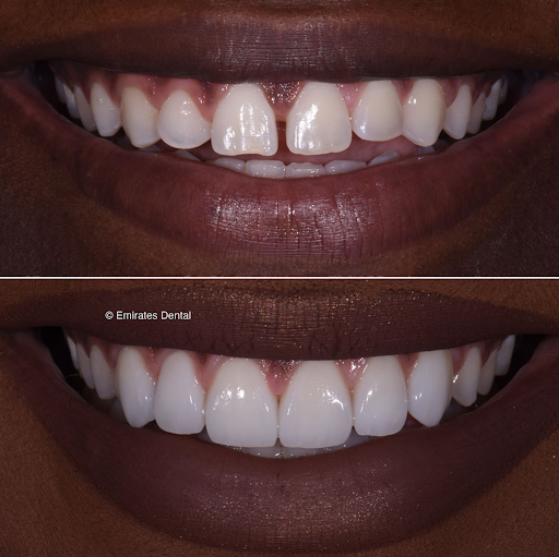 Emirates Dental - Cosmetic Dentistry & Invisalign Clinic Dubai — BEAUTY in Dubai — photo 1