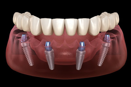Dental Implantologist UAE — HEALTHCARE in Dubai — photo 2